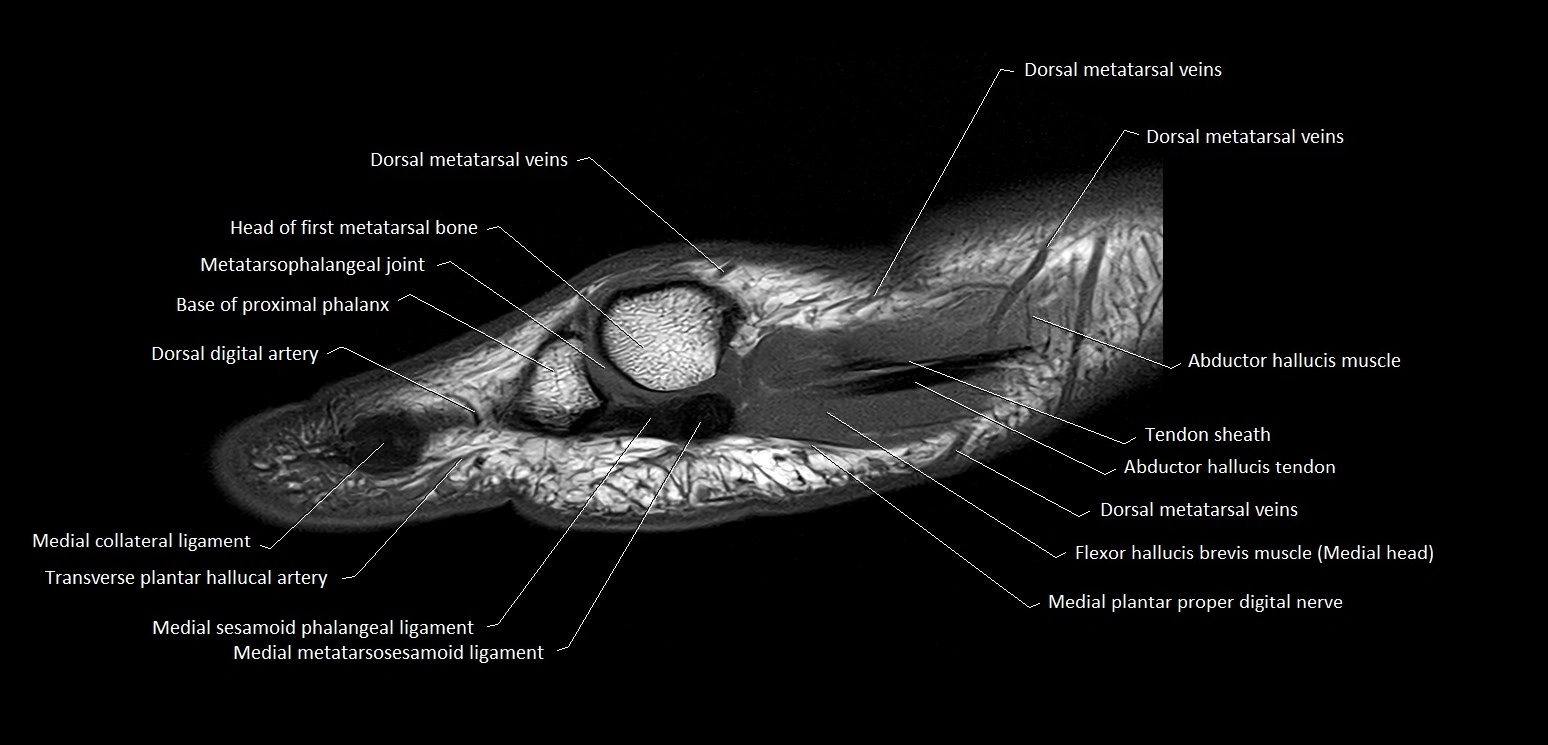 Hallux or big toe sagittal anatomy 3T MRI image 6.webp
